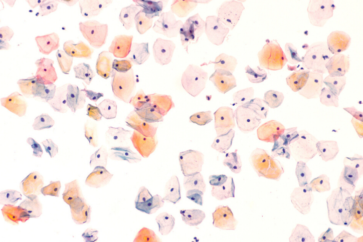 The Papanicolaou (Pap) test ("smear", stain) is a screening method to detect pre-cancerous and cancerous lesions of the uterine cervix, including HPV, "dysplasia" (LSIL, HSIL, CIN) and carcinoma.